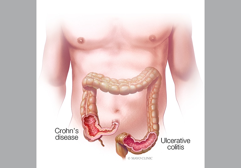 Ulcerative colitis/ Crohns disease